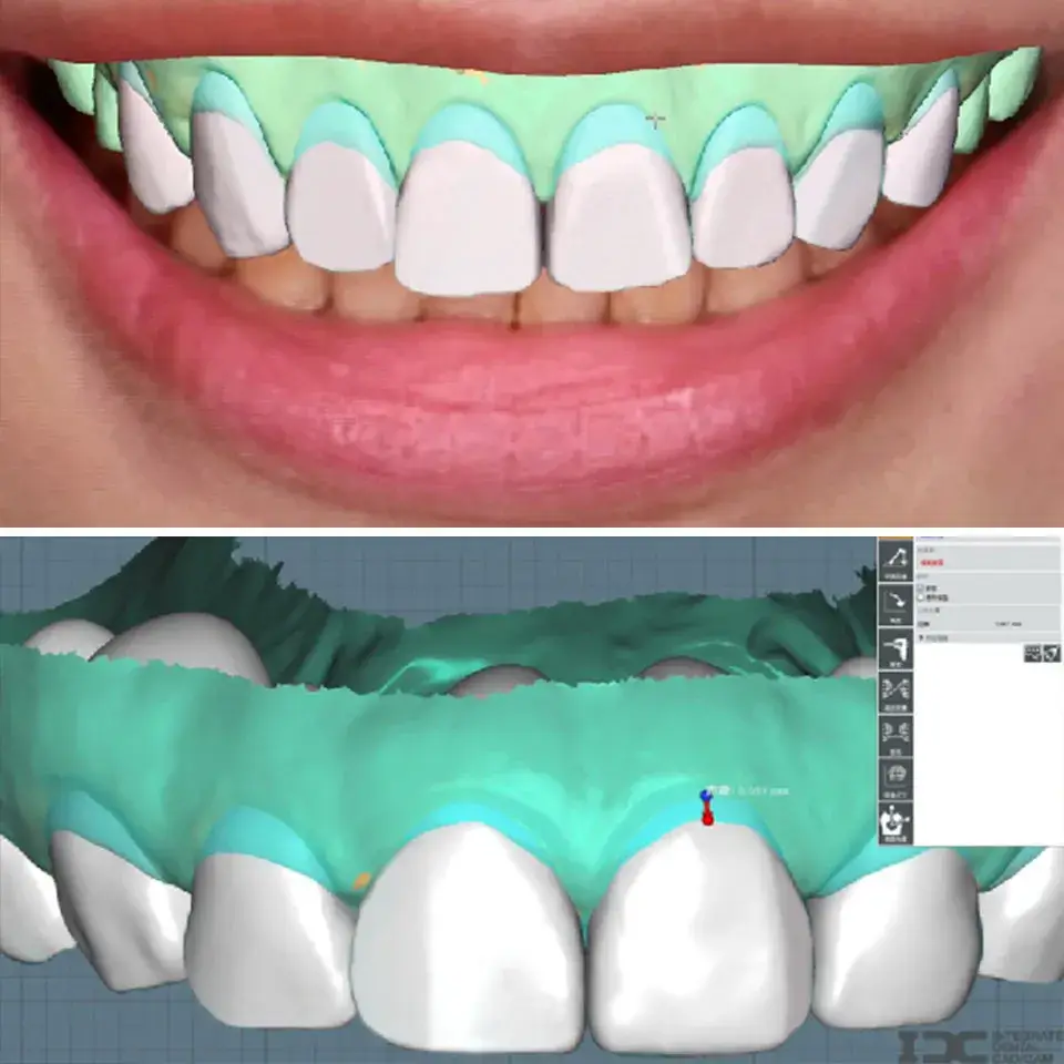 水雷射牙齦修整療程DSD數位設計圖