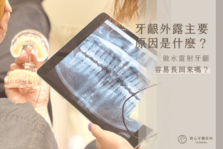 牙齦外露怎麼辦？了解主要原因以及治療笑齦外露的治療方式