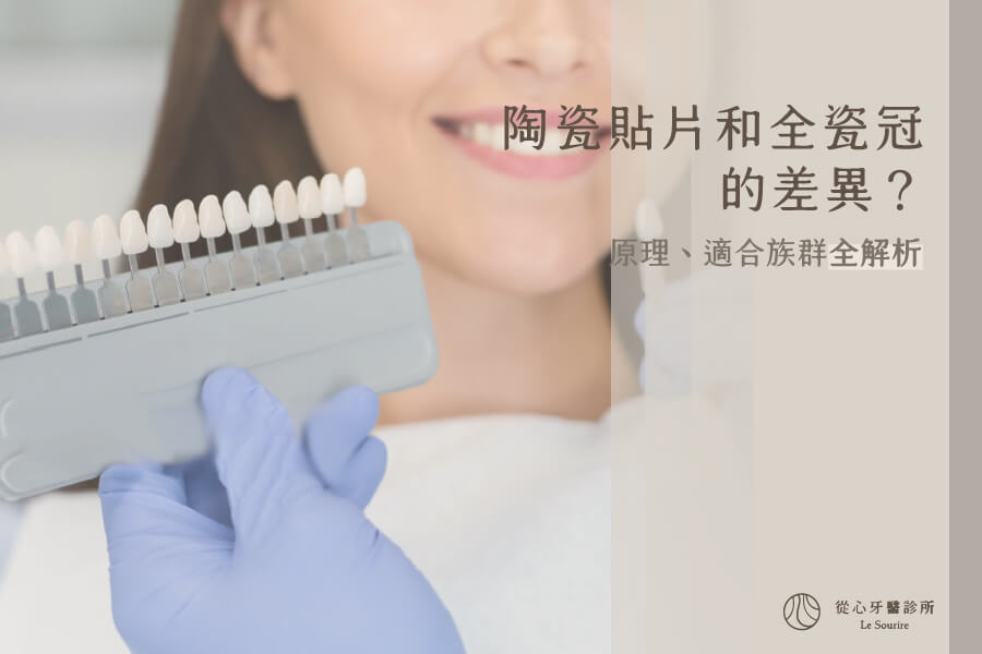 陶瓷貼片與全瓷冠核心差異分析：優缺點、適用狀況完整比較！