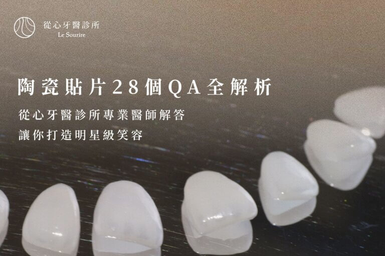 陶瓷貼片28個常見問題全解析｜從心牙醫診所專業醫師打造明星級笑容