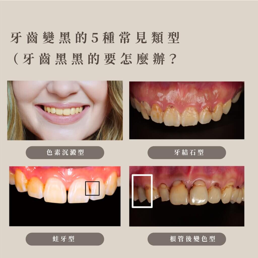 牙齒黑黑怎麼辦?5種不同成因與正確處理方式|從心牙醫診所