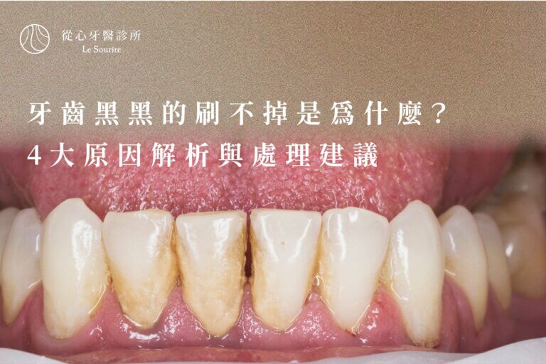 牙齒黑黑的刷不掉是為什麼？5大原因解析與處理建議｜從心牙醫診所專業解說