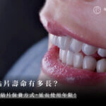 瓷牙貼片壽命有多長？