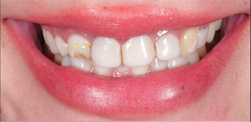 Ariel 雨凡 牙齒陶瓷貼片術前照