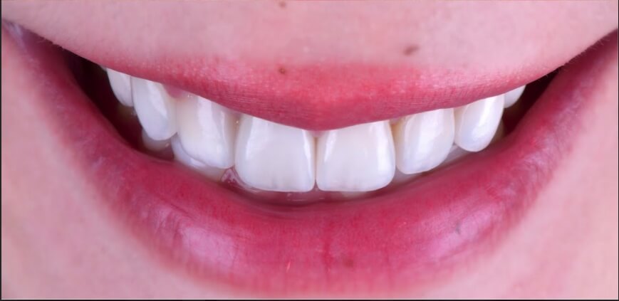 Ariel 雨凡 牙齒陶瓷貼片術後照