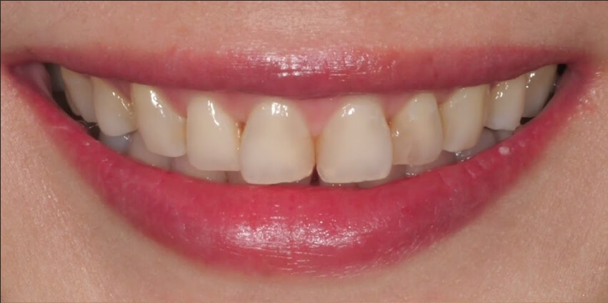 米琦琳 牙齒陶瓷貼片術前對比