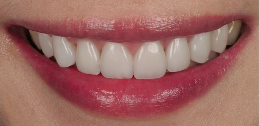 米琦琳 牙齒陶瓷貼片術後對比