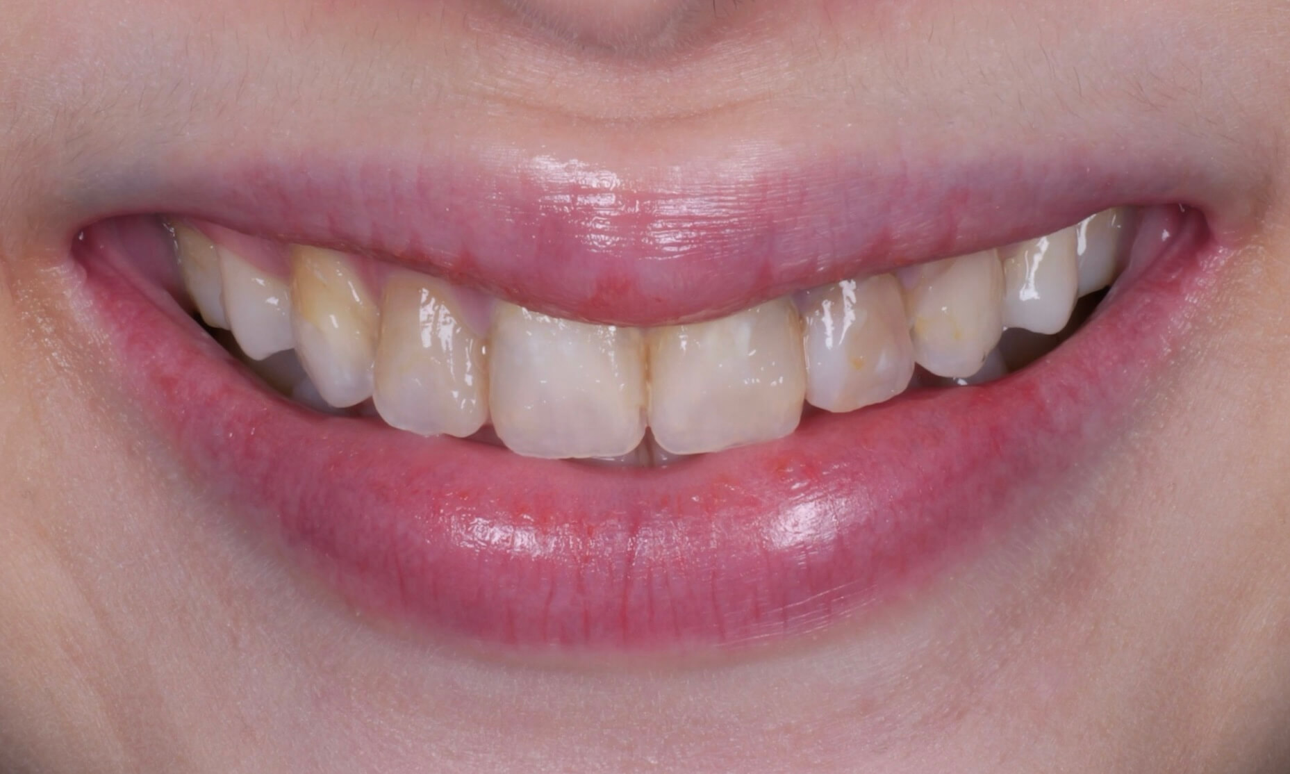 若瑀Doya 陶瓷貼片前