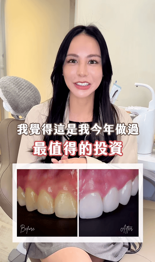 矯正後做貼片，我敢自信大笑了！